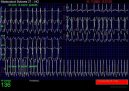 :  > Fibrilace sn (Veterinrn zkroky)